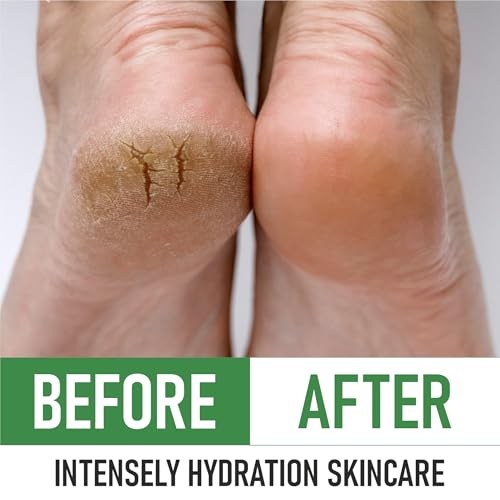 Urea 40% Foot Cream - Made in USA - Callus Remover - Moisturizes & Rehydrates Thick, Cracked, Rough, Dead & Dry Skin - For Feet, Elbows and Hands - With Pumice Stone and Brush