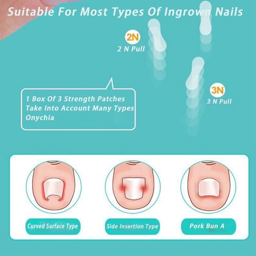 Titanium Alloy Ingrown Toenail, Ingrown Nail, Big Foot Toenail Removal Kit, Applicable for Any Size, Nail Correction Patch and Retainer (0.59/0.67/0.79in)