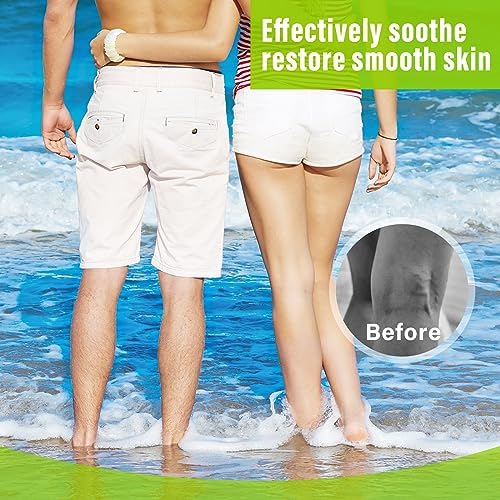 MOSKILA Varicose Veins Treatment for Legs, Nature Varicose Veins Cream, Effective Varicose Veins Treatment for Varicose & Spider Veins, Relieve Leg Swelling & Fatigue Relief, 0.7oz