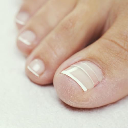 CurveCorrect® Ingrown Toenail Treatment Kit - Ingrown Toenail Corrector Kit with 10 Braces - at Home Ingrown Toenail Correction - Big Toe Ingrown Nail Treatment