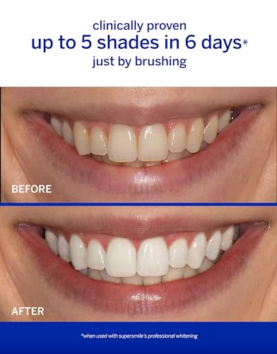 Supersmile Original Mint Whitening Kit - Professional Whitening Toothpaste + Toothbrush - Whitens 3 Shades on Average