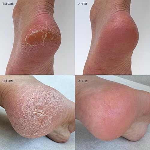 VOESH Heel Repair Duo, Solemate Heel Repair Balm & Moisturizing Heel Socks, Cracked Heel Stick Balm, Foot Care for Men & Women, at-Home Foot Care, Fuzzy Heel Socks, Toeless Spa Socks - Lavender