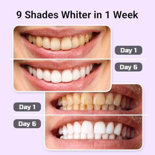 Teeth Whitening Kit – LED Light & Whitening Gel with Remineralization Syringes – Professional-Grade Whitening for Sensitive Teeth – Removes Stains from Coffee, Wine, & Smoking