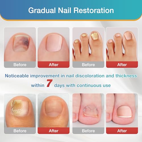 Toenail Fungus Treatment Extra Strength - 20 Hydrogel Patches for Overnight Nail Repair, 8-Hour Nighttime Fungal Nail Patches, Restores Healthy Appearance, Waterproof & Painless Relief