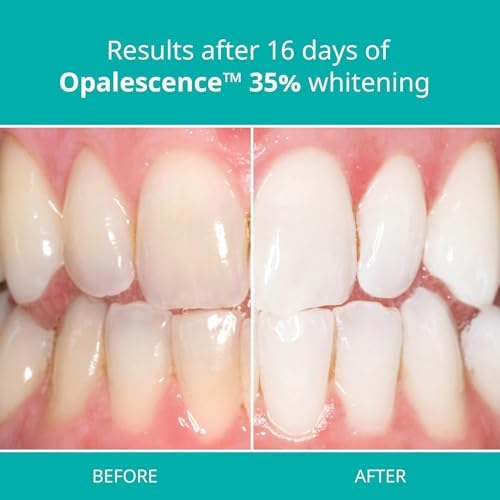 Opalescence 35% PF Teeth (4 Syringes) Whitening Refill Kit Carbamide Peroxide. Made by Ultradent. Tooth Whitening Refill Syringes Unflavored A-5197-2