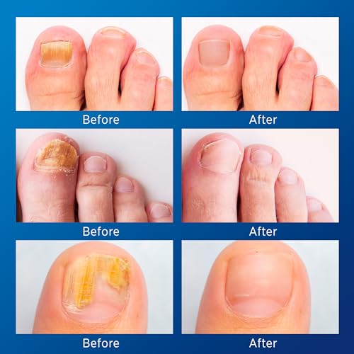 Toenail Fungus Treatment Extra Strength: (Large) 21 Patches with Hydrogel for Overnight Repair Fungus Nail Treatment For Toenail - Nighttime Nail Patches Visible Results in 8 Hours