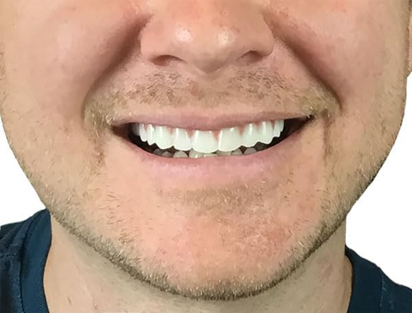 Instant Smile Comfort Fit Flex Natural Shade - Slightly Imperfect - with 2 extra fitting bead bags. One size fits most people.