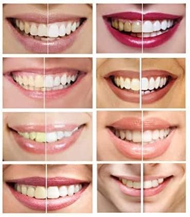 10 Syringes (3ml) New Strongest 44% Carbamide Peroxide Teeth whitening Gel (Mouth Trays NOT Included)