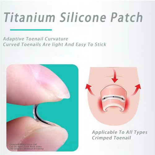 Titanium Alloy Ingrown Toenail, Ingrown Nail, Big Foot Toenail Removal Kit, Applicable for Any Size, Nail Correction Patch and Retainer (0.59/0.67/0.79in)