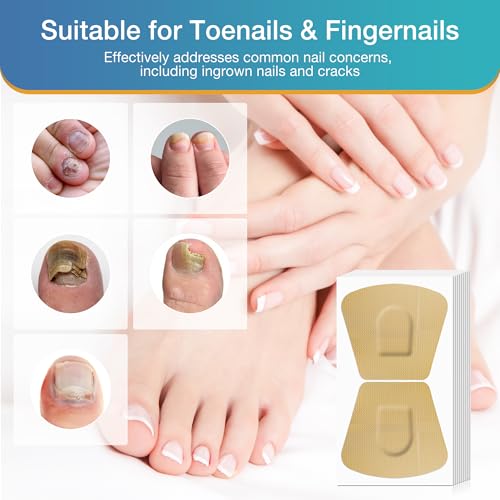 Toenail Fungus Treatment Extra Strength - 20 Hydrogel Patches for Overnight Nail Repair, 8-Hour Nighttime Fungal Nail Patches, Restores Healthy Appearance, Waterproof & Painless Relief