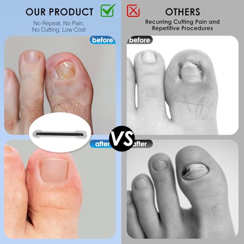 Titanium Alloy Ingrown Toenail Treatment, Ingrown Toenail Corrector Kit Specially Designed for Curved Nail Repair with Clip & Pusher & Protector Tool