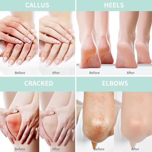 Urea Cream 50 Percent for Feet Maximum Strength 5.29 oz with Coconut and 2% Salicylic Acid, Foot & Hand Cream included Hyaluronic Acid, Tea Tree and Aloe Vera for Deep Moisturizing, Callus Removing