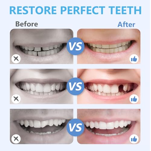 Tooth Repair Kit, Moldable Tooth Repair Kit for Broken Teeth Fixing & Missing Teeth Replacement, Safe & Effective Kit with 4 Dental Tools and 30 ml Repair Beads (Blue)