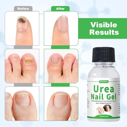 Urea Nail Gel 40% – Deeply Repairs Fungal Damage, Yellow, Black, Discolored Nail | Softens Thick Nails & Cracked Heel Calluses | Urea Gel for Nails, Fast-Absorbing, Lasting Effects, No Recurrence