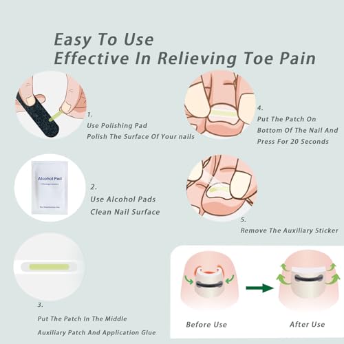 Titanium Alloy Ingrown Toenail, Ingrown Nail, Big Foot Toenail Removal Kit, Applicable for Any Size, Nail Correction Patch and Retainer (0.59/0.67/0.79in)
