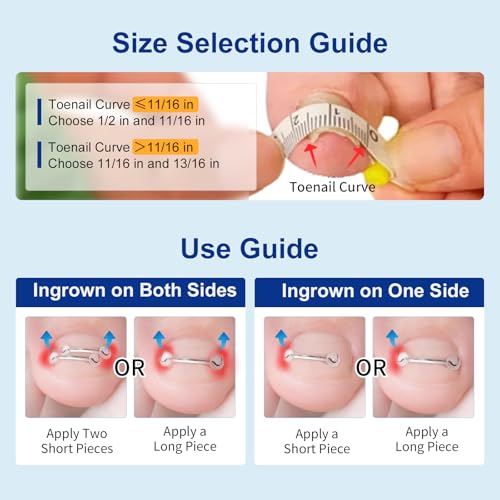 Nitinol Ingrown Toenail Corrector,at Home Ingrown Toenail Treatment,Curved Toenail Straightener,Ingrown Toe Nail Relief，Ingrown Toenail Removal Kit (11/16 In,13/16 In)