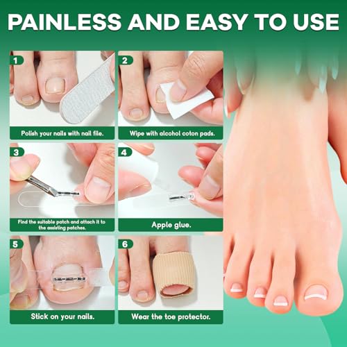 Titanium Alloy Ingrown Toenail Corrector New Version Ingrown Toenail Removal Tool Kit, Designed for Curved Nail Repair Big Toe Ingrown Toenail