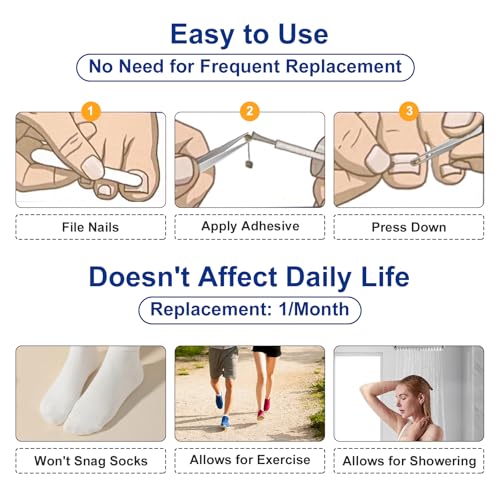 Nitinol Ingrown Toenail Corrector,at Home Ingrown Toenail Treatment,Curved Toenail Straightener,Ingrown Toe Nail Relief，Ingrown Toenail Removal Kit (11/16 In,13/16 In)