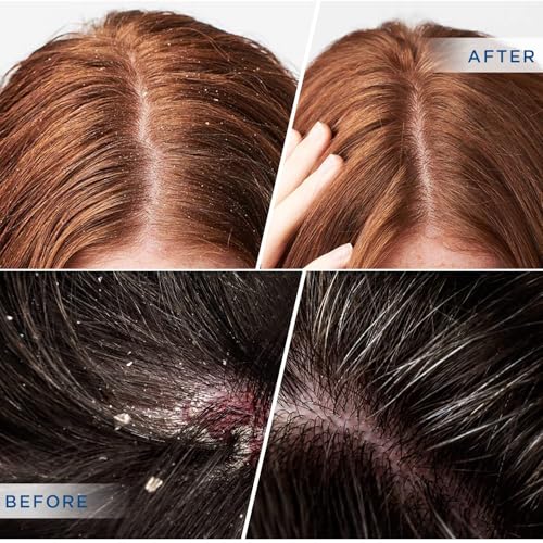 Psoriasis Shampoo: Seborrheic Dermatitis Shampoo, Folliculitis - for Eczema Dandruff Itchy Dry Scalp - Safe Ingredients for All Skin Types - 8 Fl Oz