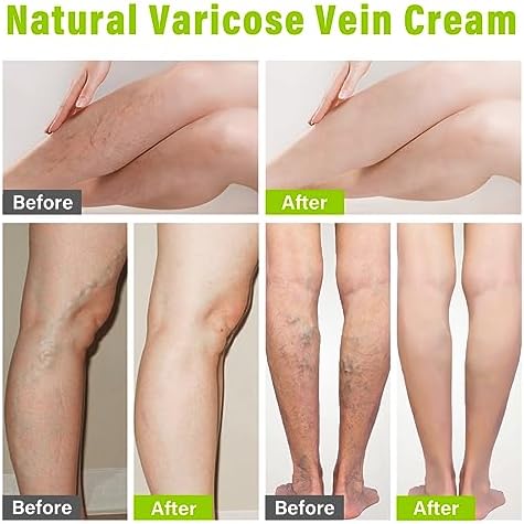 MOSKILA Varicose Veins Treatment for Legs, Nature Varicose Veins Cream, Effective Varicose Veins Treatment for Varicose & Spider Veins, Relieve Leg Swelling & Fatigue Relief, 0.7oz