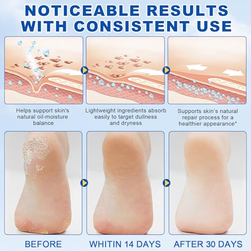 Urea 60 Percent Foot Cream Foot Care Stick Moisturizer for Dry Cracked Heels Feet Knees Elbows Hands, Foot Lotion Hydrates & Nourish Softens Skin Exfoliates Dead Skin Women and Men - 2PCS