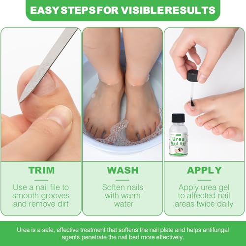 Urea Nail Gel 40% – Deeply Repairs Fungal Damage, Yellow, Black, Discolored Nail | Softens Thick Nails & Cracked Heel Calluses | Urea Gel for Nails, Fast-Absorbing, Lasting Effects, No Recurrence