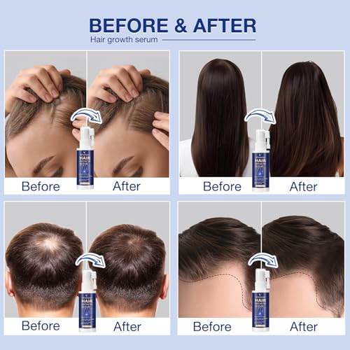 VENANOCI Hair Growth Oil Spray: with Rosemary, Biotin, Batana Oil & Rice Water – Natural Anti-Hair Loss Treatment for Thinning Hair – Promotes Thicker, Fuller Hair for Women & Men – All Hair Types