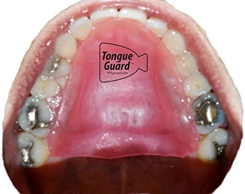 RPE Tongue Guard: Prevents and Helps Heal Tongue Sores Caused by Dental Expanders