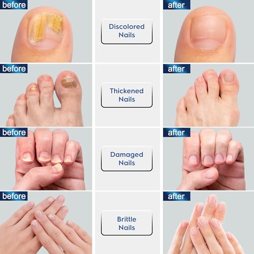 Toenail Fungus Treatment Extra Strength: Nail Fungus Treatment with 10% Undecylenic Acid, Nail Repair for Damaged Nails, Nail Fungus Treatment for Men and Women (2 Packs), Blue