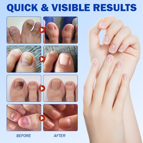 Toenail Fungus Treatment Extra Strength Nighttime Renewal Fungal Nail Patches - 21 Patch - Overnight Repair for Nail Fungus Damage, 8-Hour Treatment Restores Healthy Appearance (21 Count (Pack of 3))