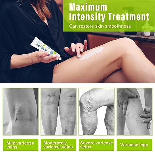 MOSKILA Varicose Veins Treatment for Legs, Nature Varicose Veins Cream, Effective Varicose Veins Treatment for Varicose & Spider Veins, Relieve Leg Swelling & Fatigue Relief, 0.7oz