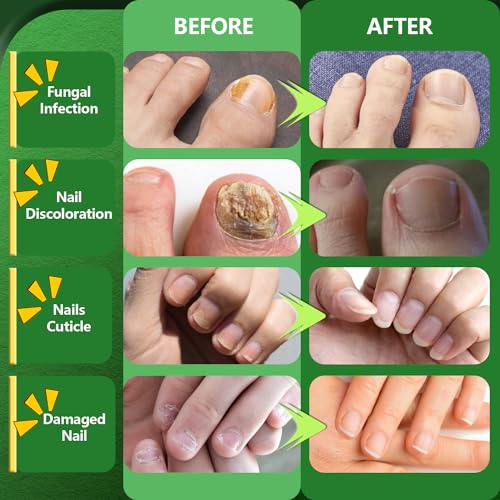 Toenail Fungus Treatment Extra Strength, Nature & Effective Nail Fungus Treatments for Fingernails & Toenail, Ingrown Toe nail Fungus Repair for Thick, Discolored & Damaged Nail