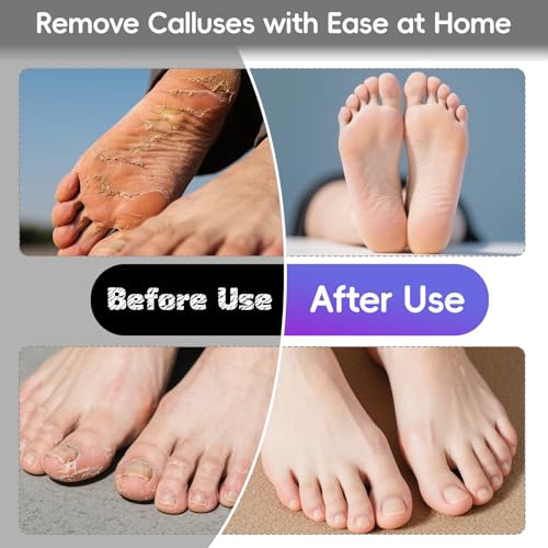 Electric Foot Callus Remover, 4.7” Callus Remover for Feet with 60Pcs Sandpaper Discs, Foot Scrubber, Professional Stepless Speed Control Pedicure Tools for Dead Skin Calluses, Purple