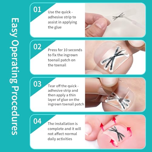 Upgraded Titanium Alloy Ingrown Toenail Corrector with Upgraded 6-Angle Shape,3x Stronger Pull Force,Ingrown Toenail Removal Kit, Ingrown Toenail Treatment for Women and Man (Large Size-6 Packs)